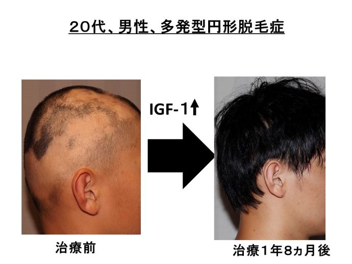 円形脱毛症　病院